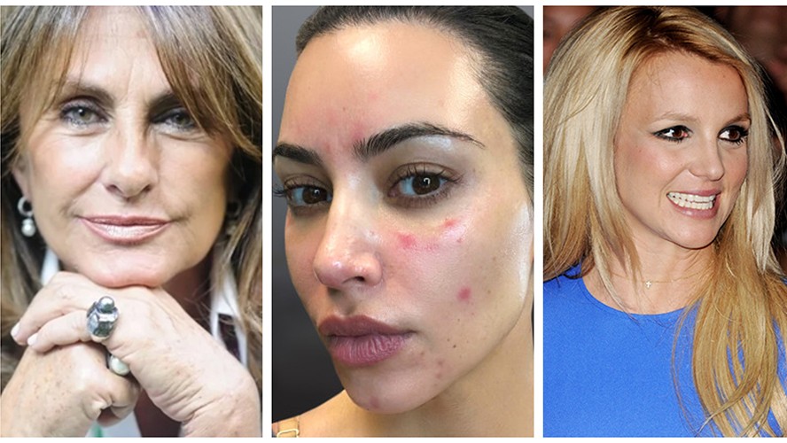 Las famosas que luchan contra la psoriasis | Salud