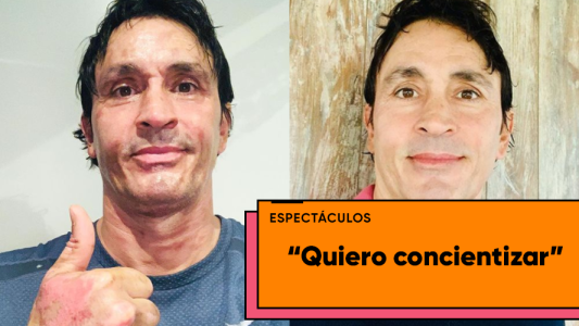 Sebastián Estevanez mostró las fotos de su rostro quemado